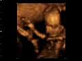 3D 4D baby scan 17  week tiny baby of Julie and Stuart remastered