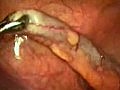 Laparoscopy Appendicectomy Video 1 ( Keyhole / Lap