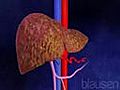 Liver Cirrosis