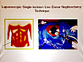 2011 UC Davis Nephrology and Transplantation: What’s New in Live Donor Kidney Transplants