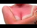 How to get quick sunburn relief
