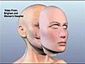 Health Watch: Woman Receives Face Transplant After Chimp Attack