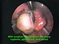 Chocolate Cyst of The Ovary