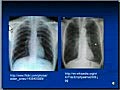 Chest x-ray interpretation &#8212; COPD and Emphysema