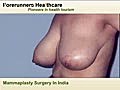 Mammaplasty Surgery