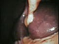 Difficult Laparoscopic Cholecystectomy