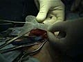 PHS in Direct Inguinal Hernia