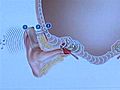 Implant Aids Single-Sided Deafness