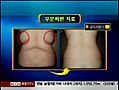 [BeS클리닉]부분지방,복부지방에 효과적인 포르테소닉지방파괴술(다이나믹지방파괴술)