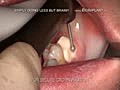 WORD`S FIRST MULTI ROOTED DENTAL IMPLANT LIVE IN LESS THAN ONE MINUTE