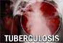 Nearly 1000 people die of TB in India everyday