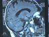 Brain-injured veterans twice as likely to develop dementia