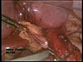 Laparoscopic Varicocelectomy