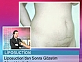 Liposuction Sonrası Normal Hayata Dönüş