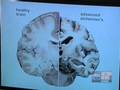 [Video] Alzheimer&#039;s: new clues