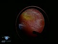 Vitrectomy For Retinal Detachment VR1 Basic Techni