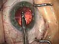 Modern Cataract Surgery