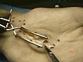 Carpal Tunnel Release Surgery