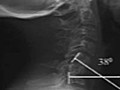 Complex Cervical Conditions