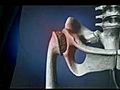 [Video] Procedure helps patients avoid hip replacement surgery