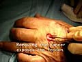 Skin Cancer Over Tendon in Hand