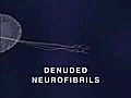 How Mercury Causes Neurodegeneration (Brain Damage)