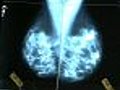 Herceptin Can Be Beneficial for Early Stage Breast Cancer