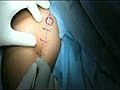 Shoulder Resurfacing Procedure JRGC Chennai - Part