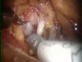 Robotic Prostatectomy Surgery HD