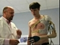 Man who cut off own arm gets bionic limb