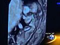 3D ear imaging may predict fetus problems