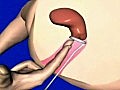 Genipap New Pap Smear Obtaining Device