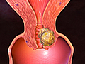 Types of Uterine Cancer