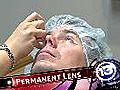 Permanent contact lenses allow patients to see clearly
