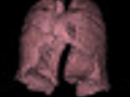 CAT Scan of chest