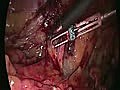 Laparoscopic inguinal hernia repair HD