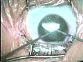 Secondary Cataract