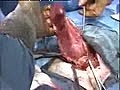 Hernia Repair (Hernioplasty)