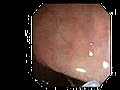 Removing a Colon Polyp