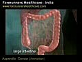 Appendix  cancer surgery in india with modern healthcare facilities