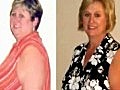 Weight Loss Surgery