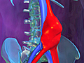 What Is an Abdominal Aortic Anuerysm?