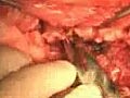 Spinal Cord Abscess Surgery