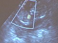 Ultrasounds Presented at Abortion Hearing