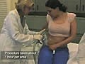 CoolSculpting by Zeltiq with NYC Doctor