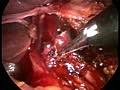 Laparoscopic Release of Celiac Artery Compression...