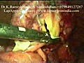 Laparoscopy Appendicectomy Video 2 (keyhole / Lap...