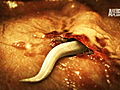 Monsters Inside Me: Worms Crawling Under My Skin