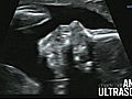 Duggars The Next Generation: Anna’s Ultrasound