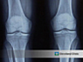 One in two adults at risk for knee arthritis.